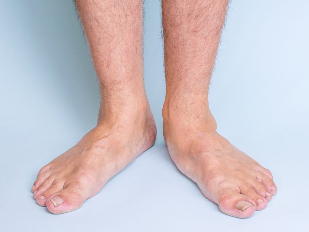 Legs of a man with a pronounced flat feet. Front view. Diseases of legs and joints.