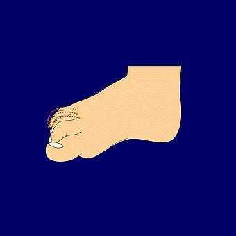 anim_hammertoes