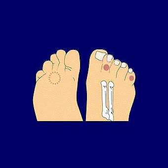 animcalluses