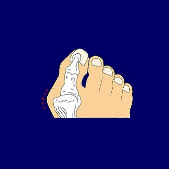 anum_bunions
